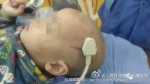 2岁小孩从床上跌落 三孔插头直接刺进头颅 - Meizhou.Cn
