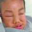 幼儿园6岁孩童疑遭教师暴打住院 园方拒绝回应 - Meizhou.Cn