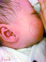 5月2日小娴出院时，小脸蛋儿上有湿疹样东西及红痕。 - 新浪广东