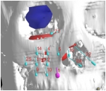 上颌窦癌3D打印模板粒子植入手术 - Southcn.Com