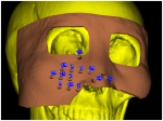 上颌窦癌3D打印模板粒子植入手术 - Southcn.Com