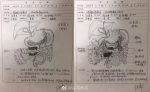 牛！63岁医生做8小时手术后不休息 画出详细手术图 - News.Timedg.Com