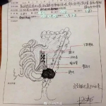 牛！63岁医生做8小时手术后不休息 画出详细手术图 - News.Timedg.Com