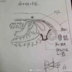 牛！63岁医生做8小时手术后不休息 画出详细手术图 - News.Timedg.Com