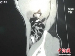     通过CT扫描出嫌疑人体内的毒品。　宁公宣　摄 - 新浪广东