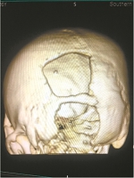 险！小伙被钢筋穿头 幸！3D打印补全颅骨 - 广东大洋网