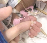 手术中，早产宝宝突然抓住医生手指 - 广东大洋网