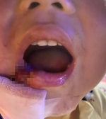 东莞4岁男童玩蹦床嘴唇竟被刺穿，原因至今还没找到！ - News.Timedg.Com
